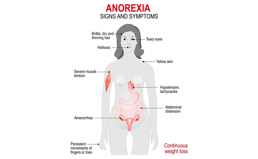 ক্ষুধাহীনতা বা অ্যানোরেক্সিয়া নার্ভোসা | লক্ষণ, কারণ ও প্রতিকার জানেন কী?