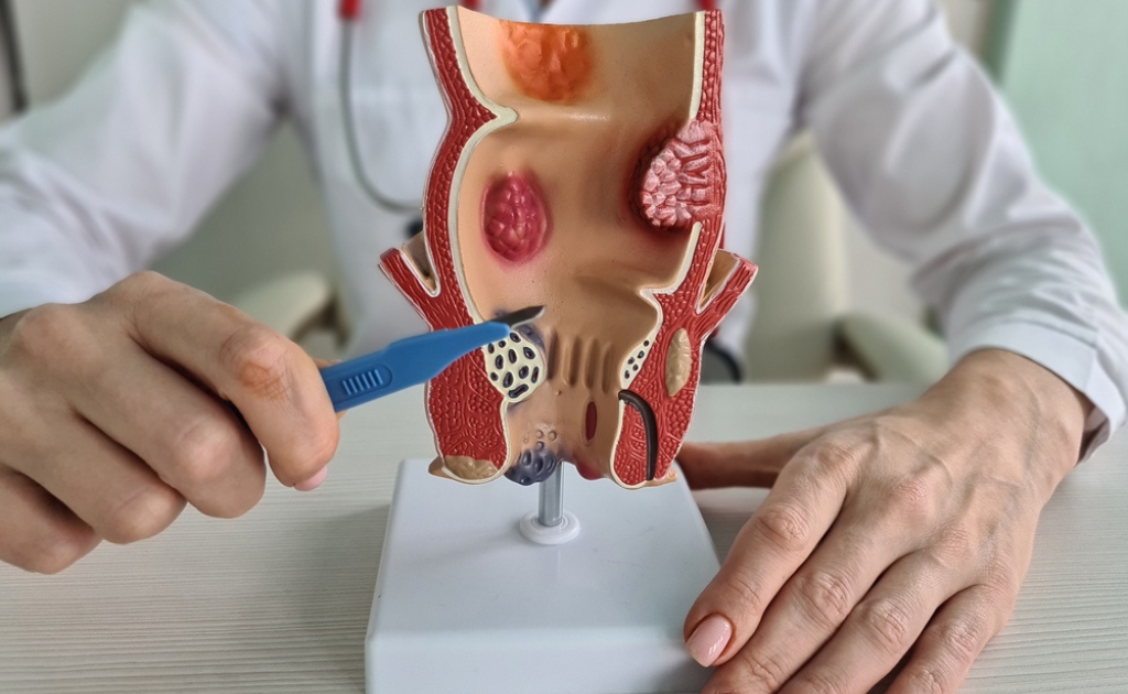 পাইলস বা অর্শ্বরোগ কেন হয়? জেনে নিন এর প্রতিকার