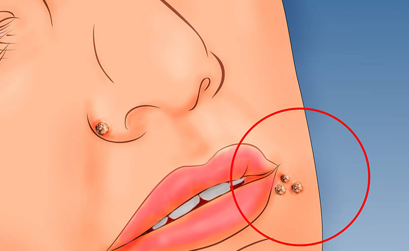 সিফিলিস বা উপদংশ | যৌন রোগটির কারণ লক্ষণ ও প্রতিরোধ জানেন তো?