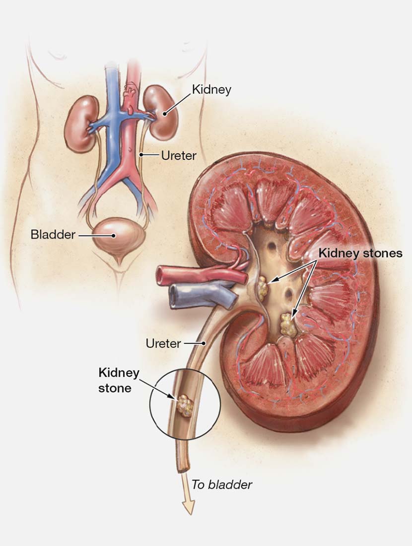 কিডনিতে পাথর | কারণ, লক্ষণ ও চিকিৎসা!