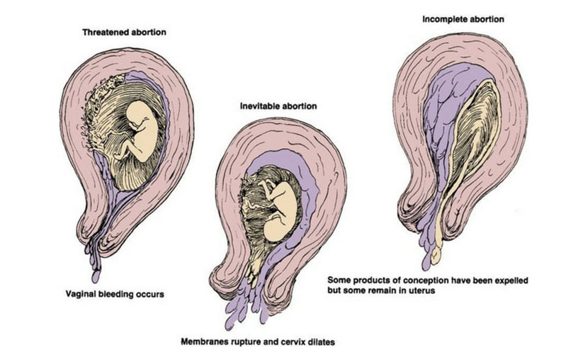 গর্ভধারণের প্রথম দিকে গর্ভপাত | জানেন কি কারণ, উপসর্গ ও প্রতিকার?