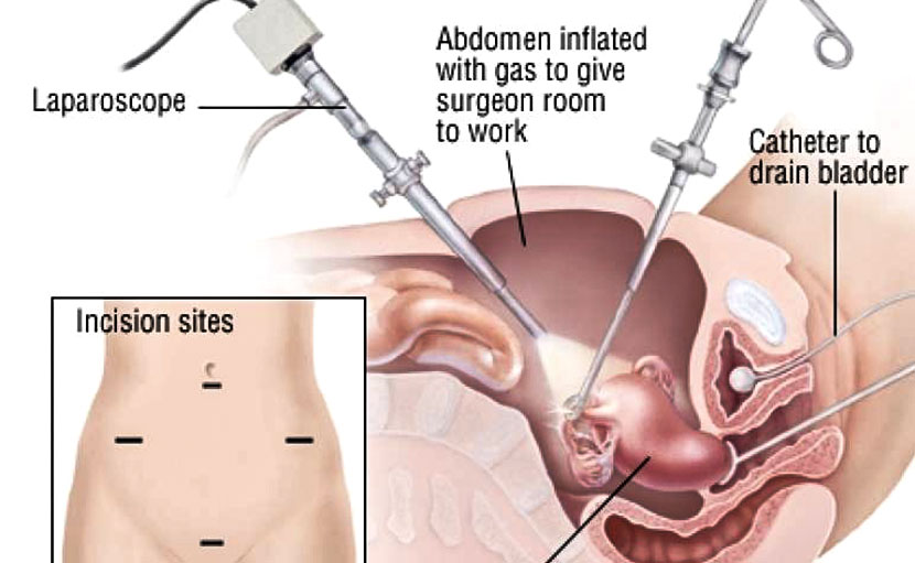 জরায়ুতে ফাইব্রয়েড এর উপসর্গ, রোগ নির্ণয় ও চিকিৎসা কি?