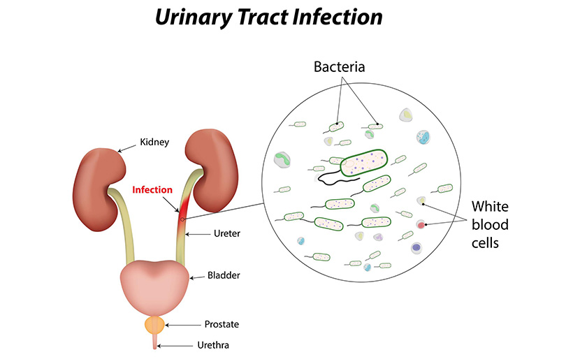মূত্রনালীর সংক্রমণ | ইউটিআই হওয়ার লক্ষণ, কারণ, চিকিৎসা ও প্রতিকার কী?