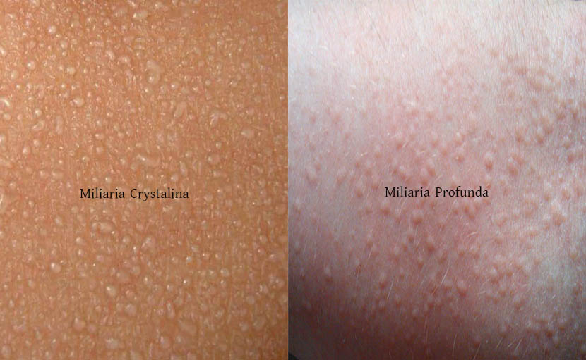 গরমে ঘামাচি হওয়ার কারণ ও নিরাময়ে ১৬টি ঘরোয়া উপায়!