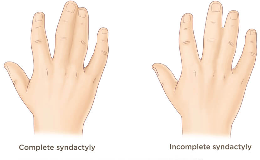 জন্মগত ত্রুটি | প্রকারভেদ ও নির্ণয় (পর্ব ১)